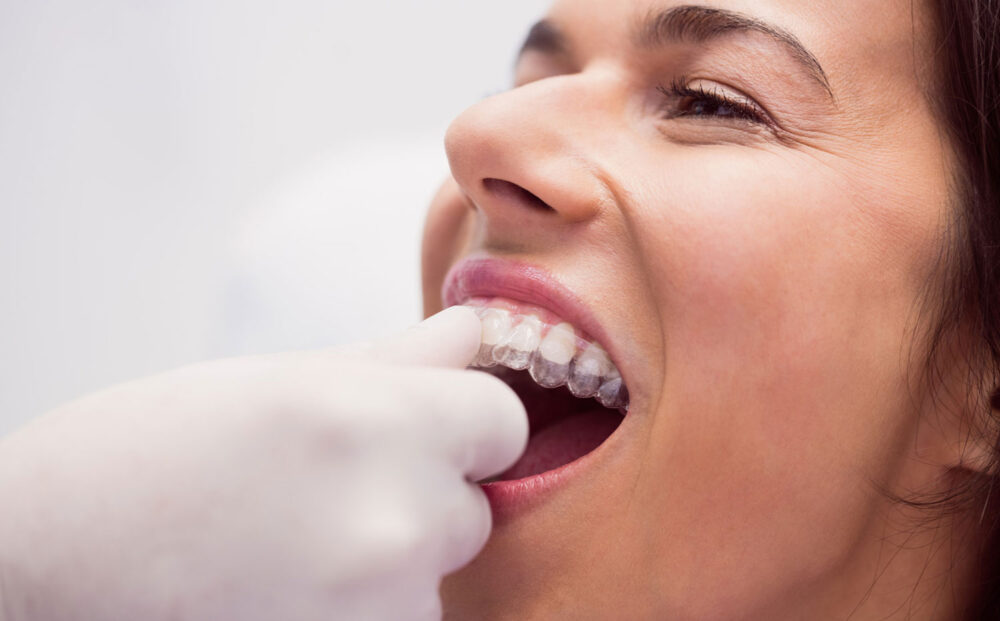 clear-aligners
