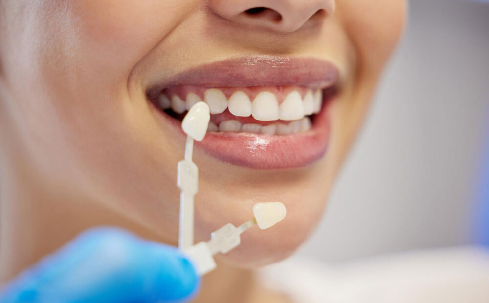 dental-veneers